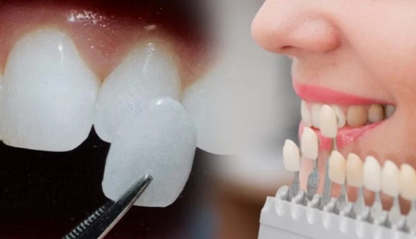 Dán sứ veneer có bền không? Nhận định từ Bác sĩ nha khoa 1 Dán sứ Veneer - Phương pháp thẩm mỹ nha khoa với lớp sứ mỏng