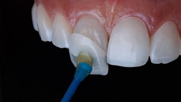 Dán sứ veneer có bền không? Nhận định từ Bác sĩ nha khoa 2 Dán sứ Veneer có bền không? Tuổi thọ trung bình là bao lâu?