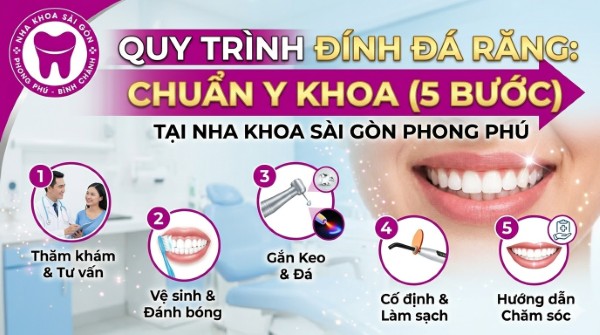 Đính đá răng là gì? Quy trình thẩm mỹ an toàn & bảng giá 7 Quy trình 5 bước đính đá răng chuẩn y khoa tại Nha khoa Sài Gòn Phong Phú