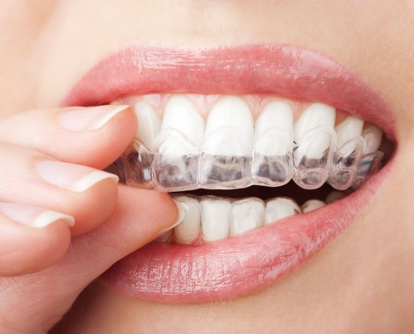 Hàm duy trì trong suốt: Ưu điểm, Bảng giá & Lưu ý khi dùng 2 Đeo hàm duy trì sau niềng răng giúp ổn định kết quả chỉnh nha