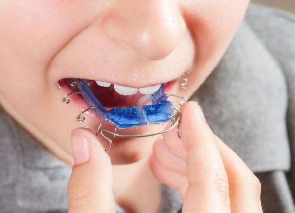 Khí cụ nong hàm là gì? Tác dụng và các loại phổ biến hiện nay 2 Tại sao cần sử dụng khí cụ nong hàm trong chỉnh nha?