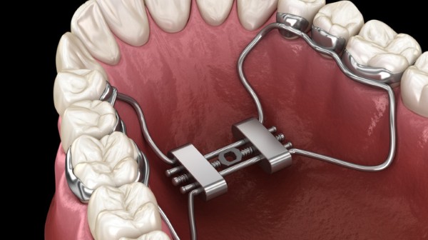 Khí cụ nong hàm là gì? Tác dụng và các loại phổ biến hiện nay 5 Nong hàm nhanh RPE (Rapid Palatal Expander)