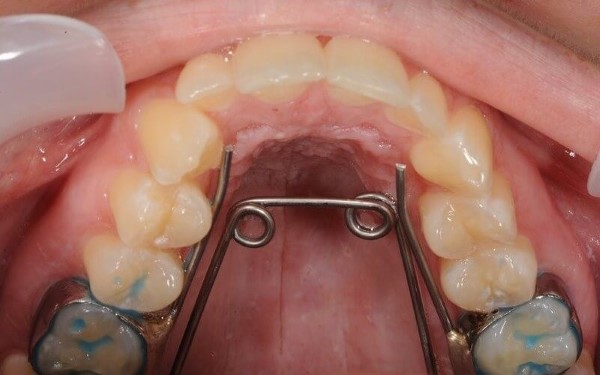 Khí cụ nong hàm là gì? Tác dụng và các loại phổ biến hiện nay 6 Nong hàm bằng dây cung & Mini-Implant hỗ trợ