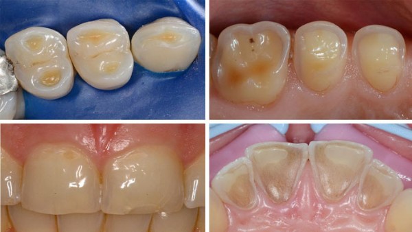 Mòn men răng: Nguyên nhân, dấu hiệu và cách điều trị hiệu quả 2 Mòn men răng có thể chia thành nhiều dạng khác nhau