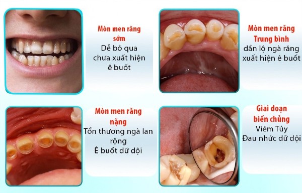 Mòn men răng: Nguyên nhân, dấu hiệu và cách điều trị hiệu quả 4 Dấu hiệu nhận biết mòn men răng theo từng giai đoạn