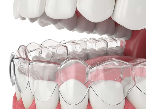 Niềng răng Invisalign là gì? Ưu điểm và quy trình chuẩn Y khoa 4 Những điều cần lưu ý để niềng răng Invisalign đạt hiệu quả tối ưu