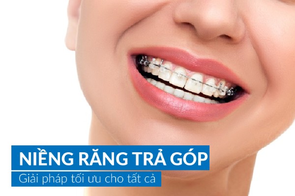 Niềng răng trả góp lãi suất 0% tại Bình Chánh | Chỉ từ 1Tr/Tháng 1 Niềng răng trả góp - Hình thức thanh toán linh hoạt cho dịch vụ chỉnh nha