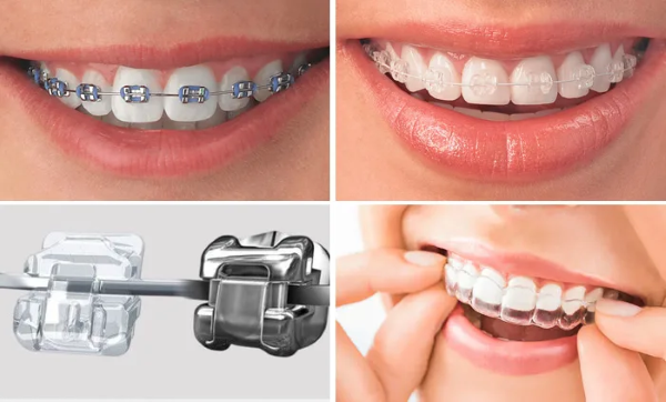 Niềng răng trả góp lãi suất 0% tại Bình Chánh | Chỉ từ 1Tr/Tháng 2 Chính sách niềng răng trả góp 0% lãi suất một trong những điểm thu hút tại Nha Khoa Sài Gòn Phong Phú