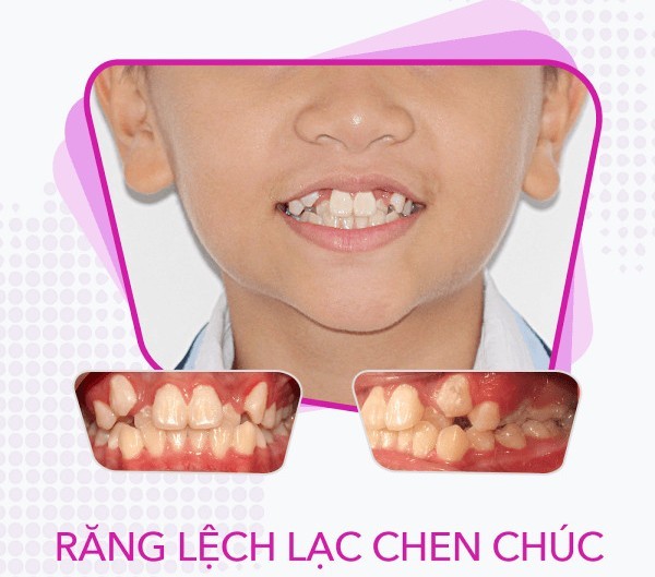 Niềng răng trẻ em: Cẩm nang từ A-Z giúp bé có nụ cười đẹp 4 Các dấu hiệu bất thường ở răng và hàm của trẻ