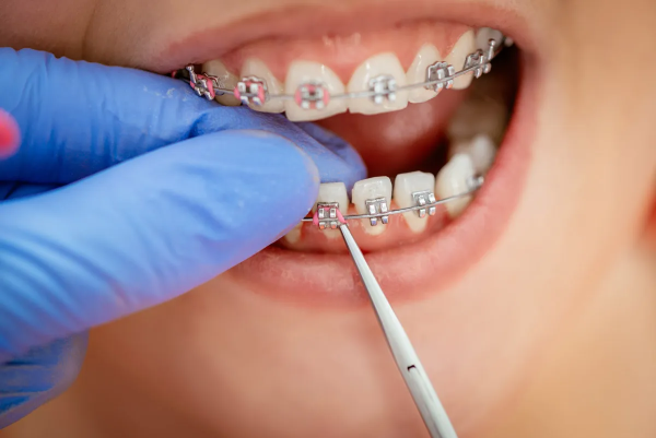 Tháo niềng răng: Quy trình thực hiện và những lưu ý quan trọng 1 Tháo niềng răng - Bước cuối cùng trong quá trình chỉnh nha