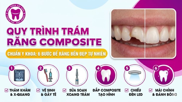 Trám răng Composite là gì? Bảng giá mới nhất tại Nha khoa 4 Quy trình 6 bước trám Răng Composite chuẩn y khoa