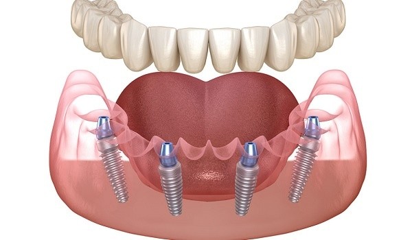 Trồng răng Implant All On 4 là gì? Ưu nhược điểm và Bảng giá 1 Trồng răng implant all on 4 - Phương pháp cấy ghép răng toàn hàm sử dụng 4 trụ implant