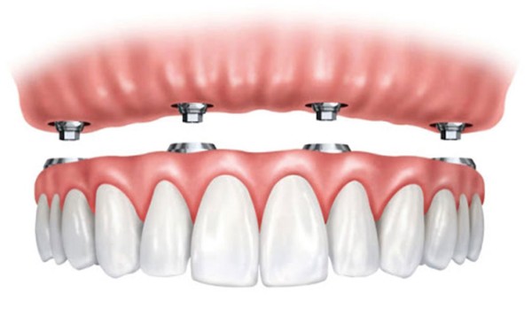 Trồng răng Implant All On 4 là gì? Ưu nhược điểm và Bảng giá 2 Ưu và nhược điểm vượt trội của phương pháp cấy ghép Implant All on 4