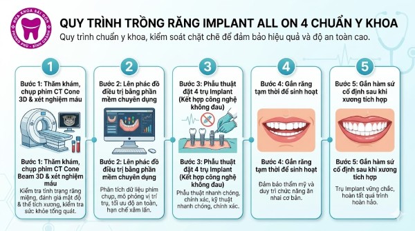 Trồng răng Implant All On 4 là gì? Ưu nhược điểm và Bảng giá 3 Quy trình 5 bước trồng răng Implant All on 4 chuẩn Y khoa