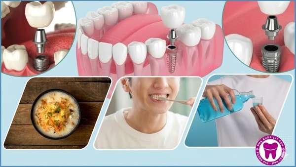 Trồng răng Implant All On 4 là gì? Ưu nhược điểm và Bảng giá 5 Cách chăm sóc sau khi cấy ghép All on 4 giúp duy trì sức khỏe răng miệng lâu dài