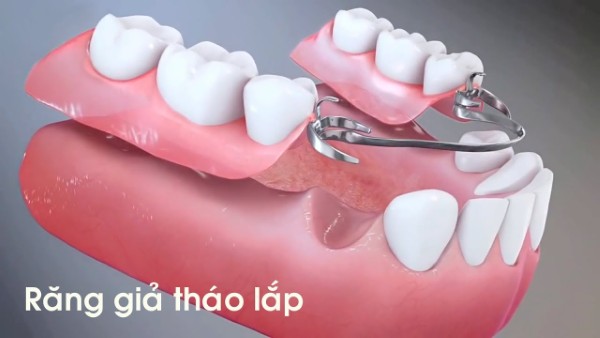 Trồng răng tháo lắp giá bao nhiêu? Bảng giá mới nhất 2026 1 Trồng răng tháo lắp - Phương pháp phục hình bằng bộ răng giả