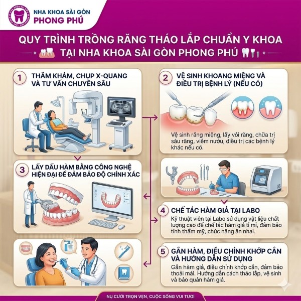 Trồng răng tháo lắp giá bao nhiêu? Bảng giá mới nhất 2026 5 Quy trình 5 bước trồng răng tháo lắp chuẩn Y khoa tại Nha Khoa Sài Gòn Phong Phú