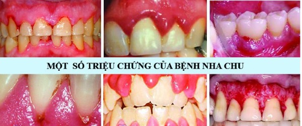 Viêm nha chu là gì? Nguyên nhân, dấu hiệu và cách điều trị 4 Một số triệu chứng của răng bị viêm nha chu