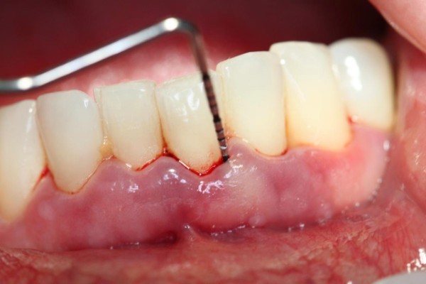 8 Cách chữa viêm nha chu răng tại nhà hiệu quả & dễ làm 1 Viêm nha chu là bệnh lý nhiễm trùng tại các mô nâng đỡ răng