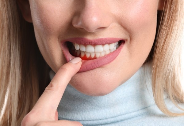8 Cách chữa viêm nha chu răng tại nhà hiệu quả & dễ làm 10 Ưu và nhược điểm khi tự điều trị viêm nha chu tại nhà