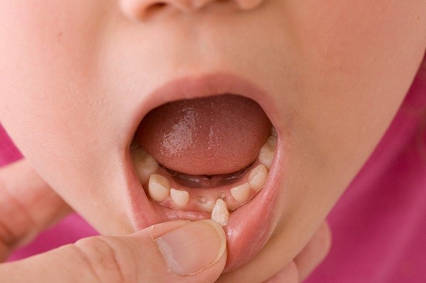 Cách nhổ răng sữa cho bé tại nhà an toàn, không đau, ít chảy máu 1 Nhổ răng sữa cho bé đúng thời điểm đóng vai trò đặc biệt quan trọng trong sự phát triển của trẻ