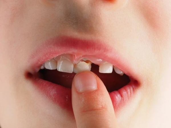 Cách nhổ răng sữa cho bé tại nhà an toàn, không đau, ít chảy máu 2 Một số trường hợp nên nhổ răng cho trẻ