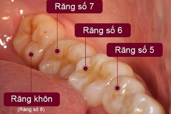 Răng số 6 có thay không? Giải đáp từ chuyên gia Nha khoa 1 Vị trí răng số 6 trong cấu trúc hàm răng