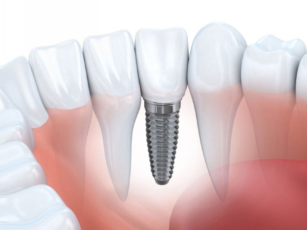 Răng số 6 có thay không? Giải đáp từ chuyên gia Nha khoa 8 Trồng răng Implant - Phương pháp hiện đại và hiệu quả nhất