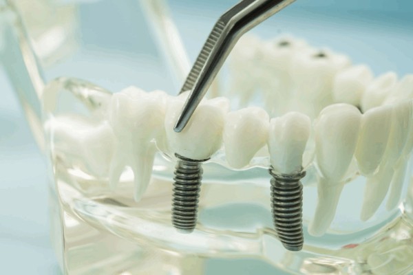 Trồng răng sứ vĩnh viễn giá bao nhiêu? Bảng giá mới nhất 2026 2 Implant nha khoa - Giải pháp được đánh giá cao nhất về độ bền và tính ổn định lâu dài