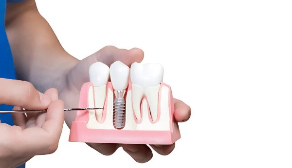 Trồng răng sứ vĩnh viễn giá bao nhiêu? Bảng giá mới nhất 2026 5 Trồng răng sứ vĩnh viễn giá bao nhiêu phụ thuộc vào nhiều yếu tố khác nhau