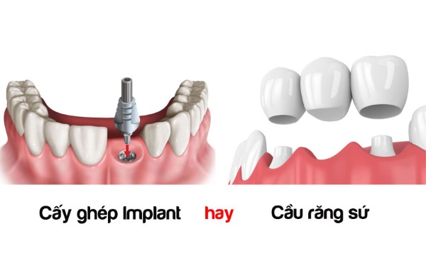 Trồng răng sứ vĩnh viễn giá bao nhiêu? Bảng giá mới nhất 2026 6 Nên chọn trồng răng Implant hay Cầu răng sứ?