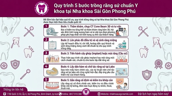 Trồng răng sứ vĩnh viễn giá bao nhiêu? Bảng giá mới nhất 2026 7 Quy trình 5 bước trồng răng sứ chuẩn Y khoa tại Nha khoa Sài Gòn Phong Phú