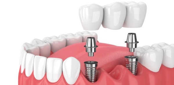 Trồng răng sứ vĩnh viễn giá bao nhiêu? Bảng giá mới nhất 2026 3 Phương pháp trồng răng Implant