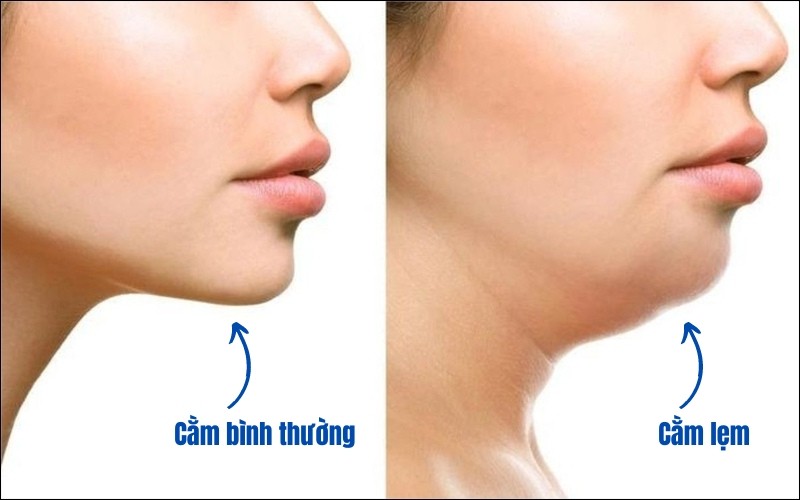 Cằm lẹm là gì? Nguyên nhân, dấu hiệu và cách khắc phục hiệu quả 1 Cằm lẹm là gì? Đặc điểm nhận dạng chuẩn xác