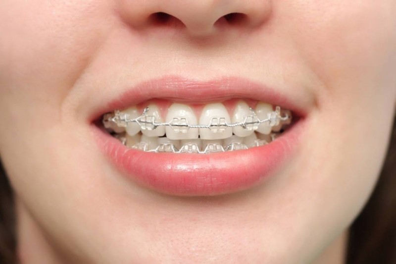 Cằm lẹm là gì? Nguyên nhân, dấu hiệu và cách khắc phục hiệu quả 5 Niềng răng thẩm mỹ - Khắc phục tình trạng cằm lẹm do răng