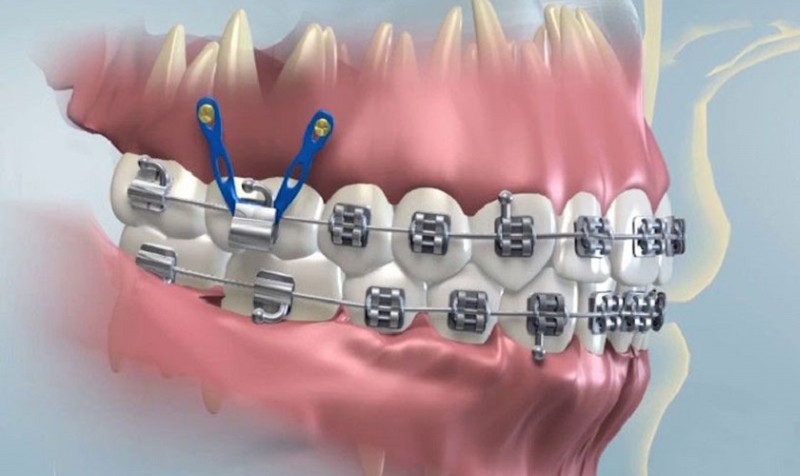 Đánh lún răng bằng dây cung là gì? Ưu điểm & Quy trình thực hiện 1 Đánh lún răng bằng dây cung trong nha khoa