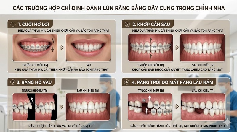 Đánh lún răng bằng dây cung là gì? Ưu điểm & Quy trình thực hiện 2 Các trường hợp bác sĩ chỉ định sử dụng phương pháp đánh lún răng bằng dây cung