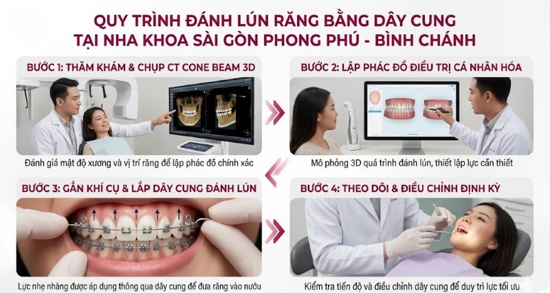 Đánh lún răng bằng dây cung là gì? Ưu điểm & Quy trình thực hiện 4 Quy trình đánh lún răng chuẩn y khoa tại Nha khoa Sài Gòn Phong Phú