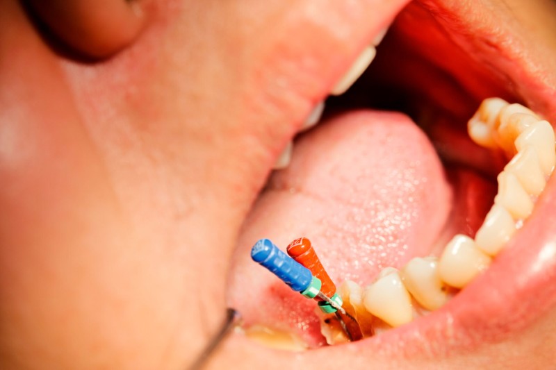 Điều trị tủy răng mất bao lâu? Quy trình chuẩn Y Khoa 2 Điều trị tủy răng mất bao lâu tùy thuộc vào nhiều yếu tố khác nhau