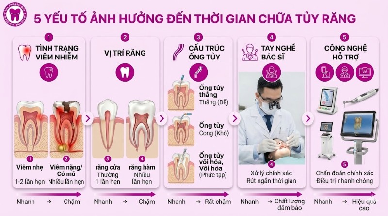 Điều trị tủy răng mất bao lâu? Quy trình chuẩn Y Khoa 3 5 yếu tố ảnh hưởng đến quy trình điều trị tủy răng