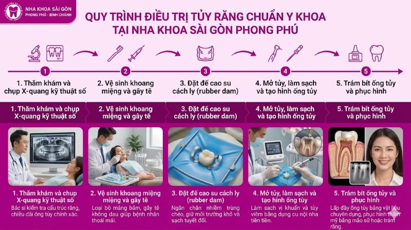 Điều trị tủy răng mất bao lâu? Quy trình chuẩn Y Khoa 4 Quy trình 5 bước điều trị tủy răng chuẩn Y khoa tại Nha khoa Sài Gòn Phong Phú