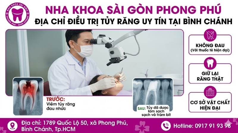 Điều trị tủy răng mất bao lâu? Quy trình chuẩn Y Khoa 5 Nha khoa Sài Gòn Phong Phú – Địa chỉ điều trị tủy răng uy tín tại Bình Chánh