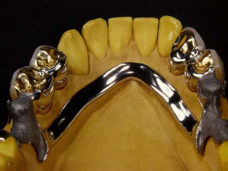 Hàm khung liên kết là gì? Có nên làm hàm khung liên kết? 1 Hàm khung liên kết - Phương pháp phục hồi răng bằng khung kim loại