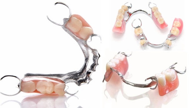 Hàm khung liên kết là gì? Có nên làm hàm khung liên kết? 3 Hàm khung liên kết bằng móc kim loại