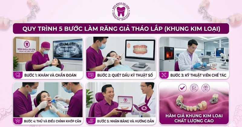 Hàm khung liên kết là gì? Có nên làm hàm khung liên kết? 6 Quy trình làm hàm khung liên kết chuẩn Y khoa tại Nha khoa Sài Gòn Phong Phú
