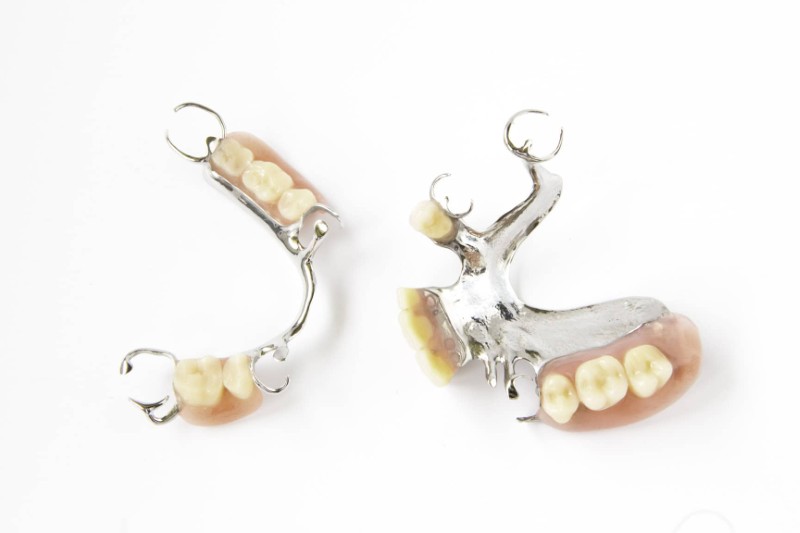 Hàm khung tháo lắp là gì? Ưu nhược điểm & Bảng giá mới nhất 1 Hàm khung tháo lắp trong chỉnh nha