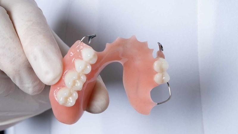 Hàm khung tháo lắp là gì? Ưu nhược điểm & Bảng giá mới nhất 2 Ưu và nhược điểm của hàm khung tháo lắp
