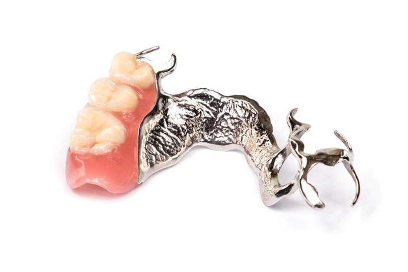 Hàm khung tháo lắp là gì? Ưu nhược điểm & Bảng giá mới nhất 4 Hàm khung Titan được đánh giá cao về độ bền và độ tương thích cao