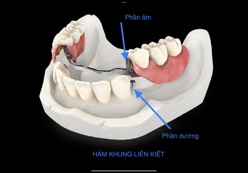 Hàm khung tháo lắp là gì? Ưu nhược điểm & Bảng giá mới nhất 5 Hàm khung kết hợp liên kết Precision