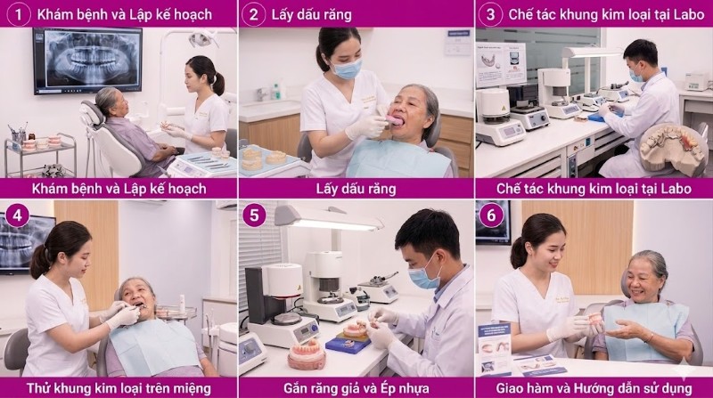 Hàm khung tháo lắp là gì? Ưu nhược điểm & Bảng giá mới nhất 6 Quy trình thực hiện hàm khung tại Nha khoa Sài Gòn Phong Phú
